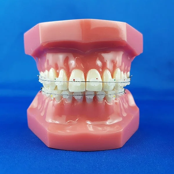 modello didattico dimostrativo bocca chiusa umana ortodonzia con brackets metallici e filo in acciaio