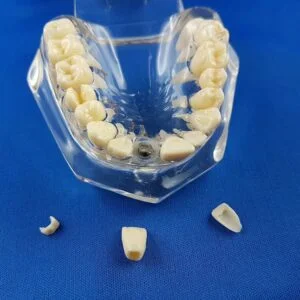 vista palato superiore bocca umana trasparente patologica