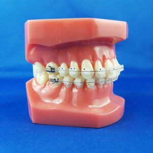 modello didattico dimostrativo bocca chiusa laterale sinistra umana ortodonzia con brackets metallici e filo in acciaio