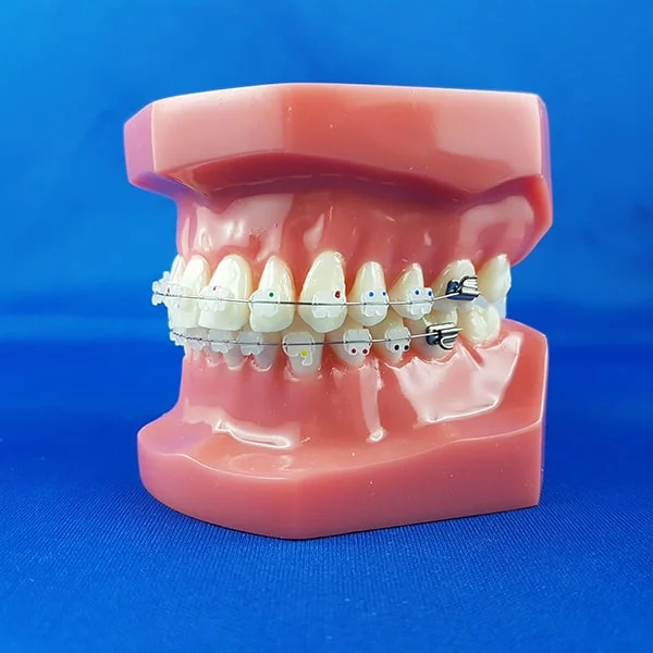 modello didattico dimostrativo bocca chiusa laterale destra umana ortodonzia con brackets metallici e filo in acciaio