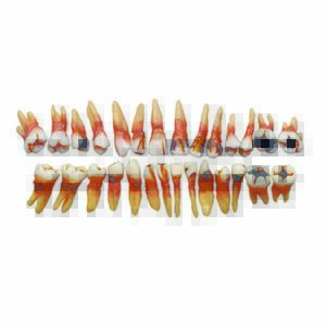 Bocca patologica su occlusore