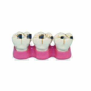 Denti dimostrativi della carie