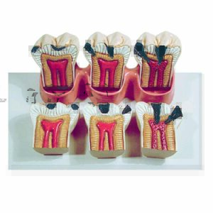 Denti dimostrativi della carie