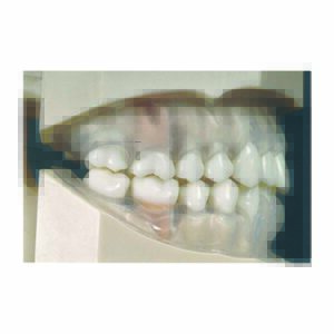 Modello di bocca umana per esercitazioni con gengive parontopatiche in gomma trasparenti