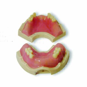 Casistica di base di protesi con supporto implantare con gengiva asportabile