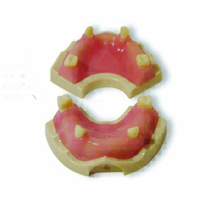 Casistica di base di protesi a supporto implantare con gengiva rosa