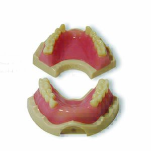 Casistica di base di protesi a supporto implantare con gengiva