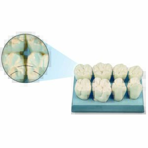 Corone ingrandite dei denti antagonisti posteriori di un'emiarcata