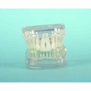 Malocclusione classe II - 2° divisione