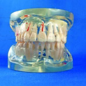 Modello trasparente dimostrativo patologico adulto completo di occlusore